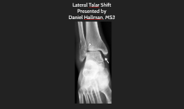 Lateral Talar Shift by Daniel Hallman on Prezi