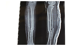 tib fib fracture and arthritis