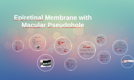 Epiretinal Membrane With Macular Pseudohole By Leann Jaroczynski On Prezi Epiretinal Membrane With Macular Pseudohole By Leann Jaroczynski On Prezi