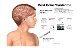 post polio syndrome post polio syndrome