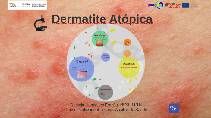 Dermatite Atópica by Daniela Frazão on Prezi