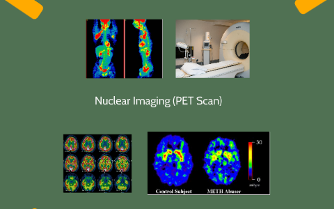 Nuclear Imaging (PET & SPECT Scan) by Matteo Stradiotto on Prezi