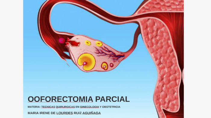 Acerca de Ooforectomía en el extranjero - Intclinics