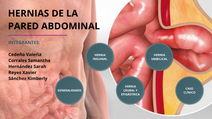 HERNIAS DE LA PARED ABDOMINAL by Sarah María Hernández Miniet on Prezi