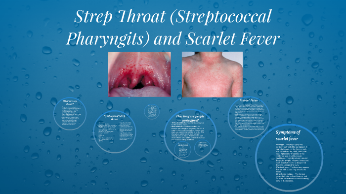 Scarlet Fever  Concise Medical Knowledge