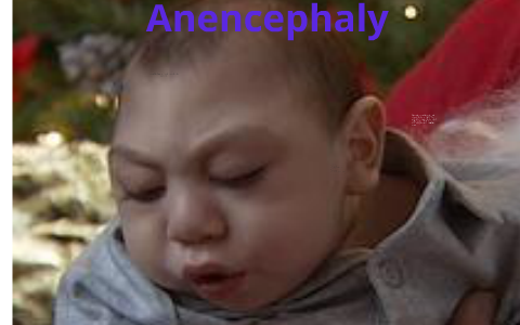 Anencephaly baby