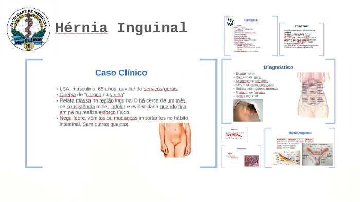 Hérnia Inguinal by Bruno Rangel on Prezi