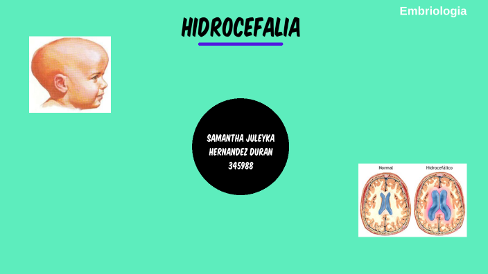 Hidrocefalia By Samantha Juleyka Hernandez Duran 6310