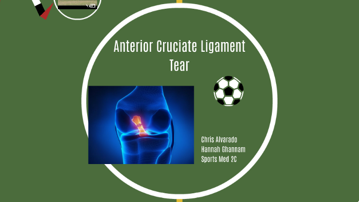 Anterior Cruciate Ligament Tear by Hannah Payne