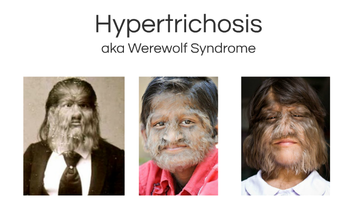 Werewolf syndrome
