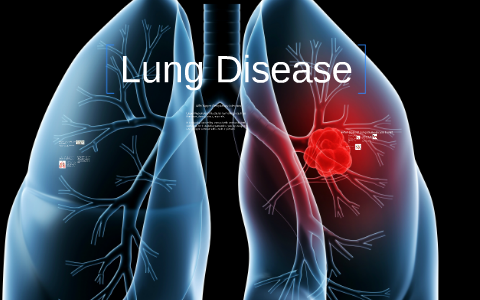 Lung Disease by Poop Poopet on Prezi