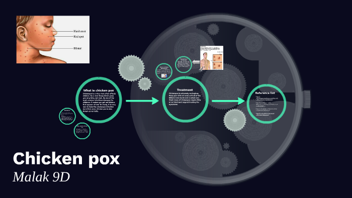 Chicken pox by malak ahmed on Prezi