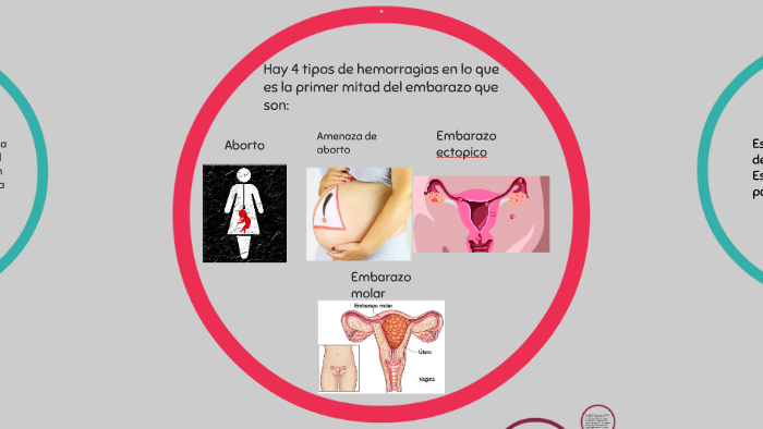 Hemorragias en la primer mitad del embarazo by Ezmeraldiitha Aviila on  Prezi Next