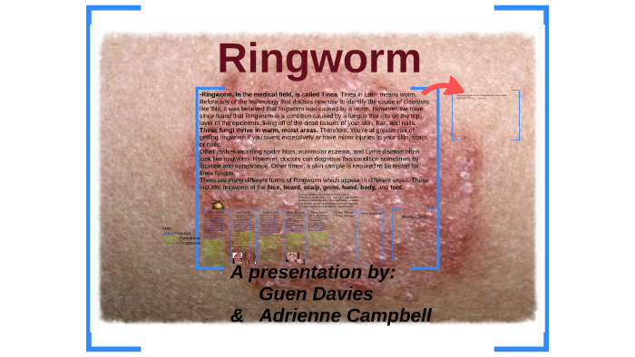 Ringworm by Guennie DeLanning on Prezi