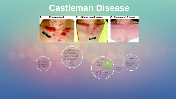 Castleman Disease by Chanise Dixon on Prezi