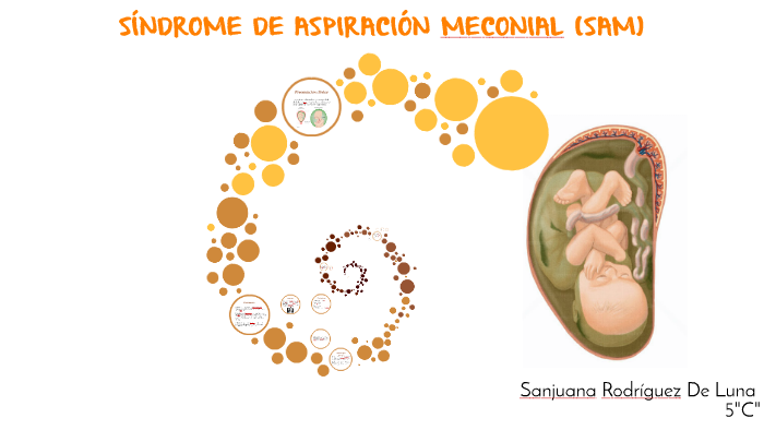 Síndrome de aspiración meconial (SAM) by Sanjuana Rodríguez De Luna on