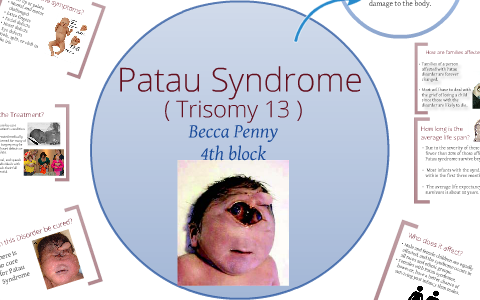 patau syndrome chromosomes