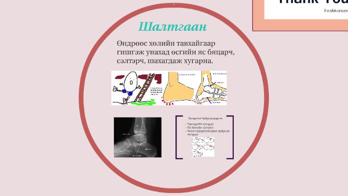 Өсгий ясны хугарал by Сүхбат Наранзаяа on Prezi