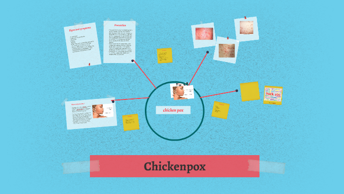What is Chicken Pox? by Michelle Oparah on Prezi