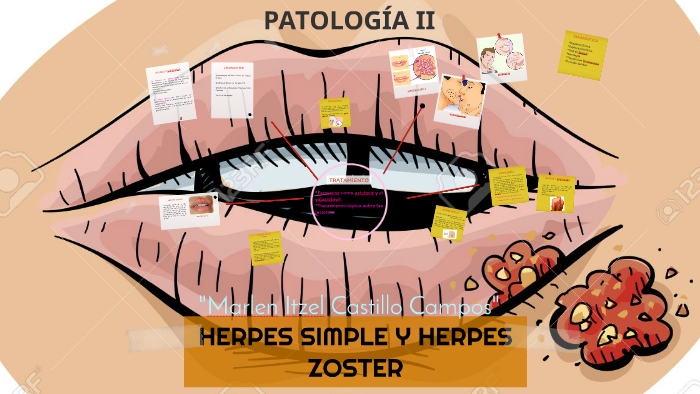 HERPES SIMPLE Y HERPES ZOSTER by Tere Fernandez