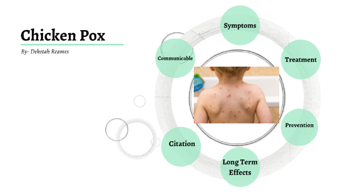 Chicken Pox by Dekotah Reames on Prezi
