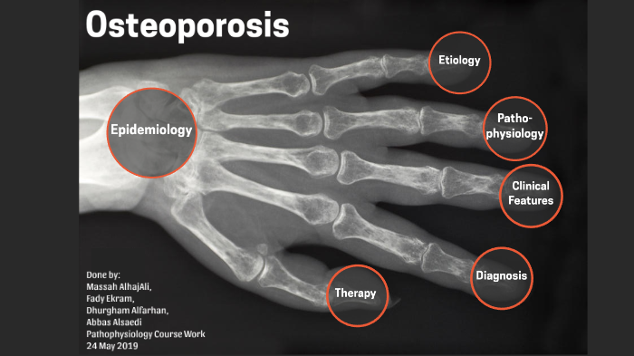 Osteoporosis by masah al haj ali on Prezi