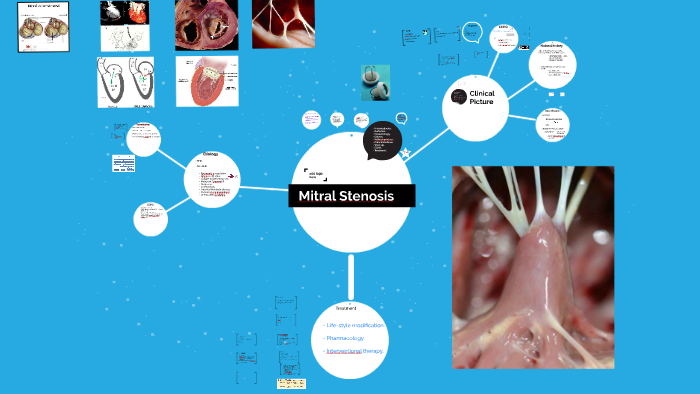 mitral-stenosis-by-hasan-alkhatib