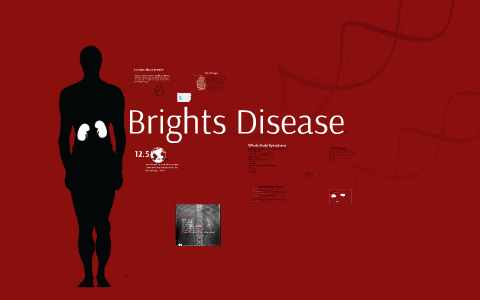 Brights Disease Presentation by Rachel Housser