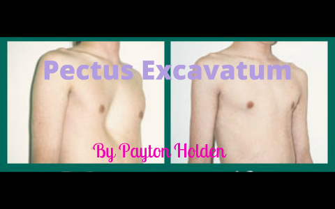 Pectus Excavatum by Payton Holden on Prezi