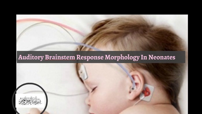 Auditory Brainstem Response Morphology In Neonates by Mai Hamdy on Prezi