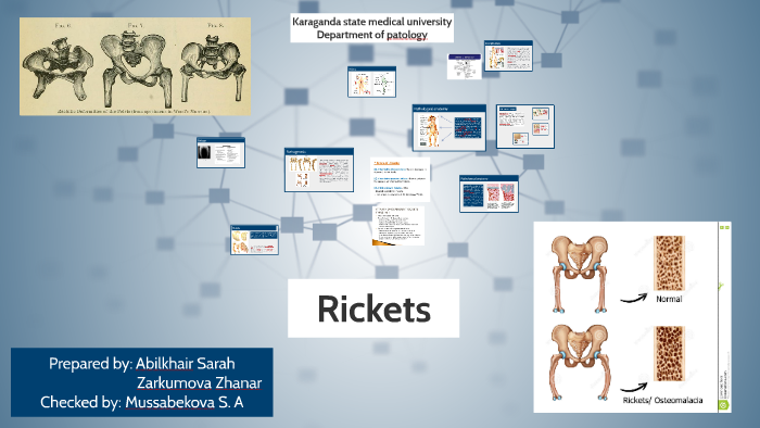 Rickets Disease In Third World Countries