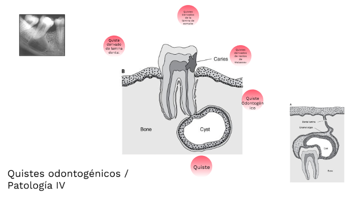 quiste odontogénico glandular