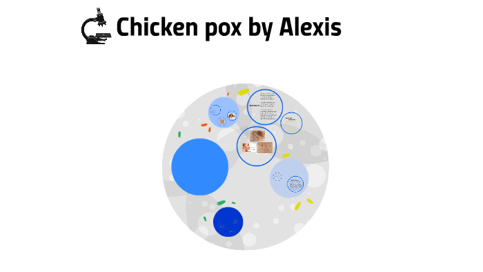 Chicken pox by N.I.P FRIDEBERG on Prezi