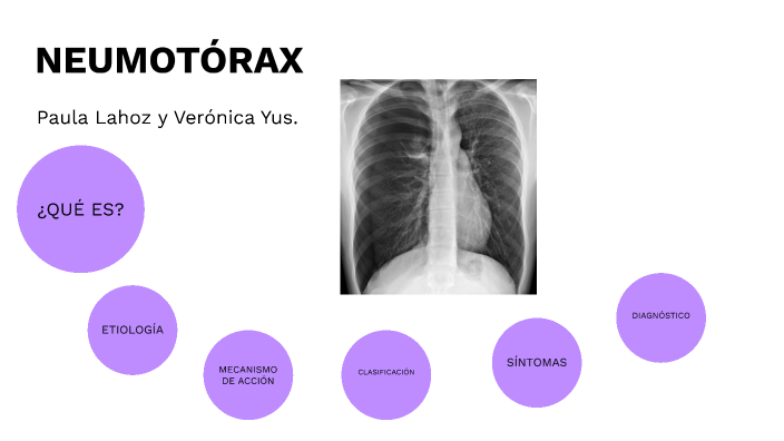NEUMOTÓRAX by Paula LAHOZ on Prezi