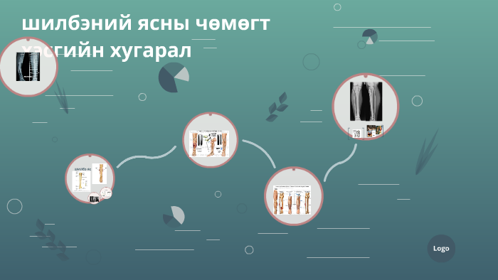 шилбэний ясны чөмөгт хэсгийн хугарал by bindka binderya on Prezi