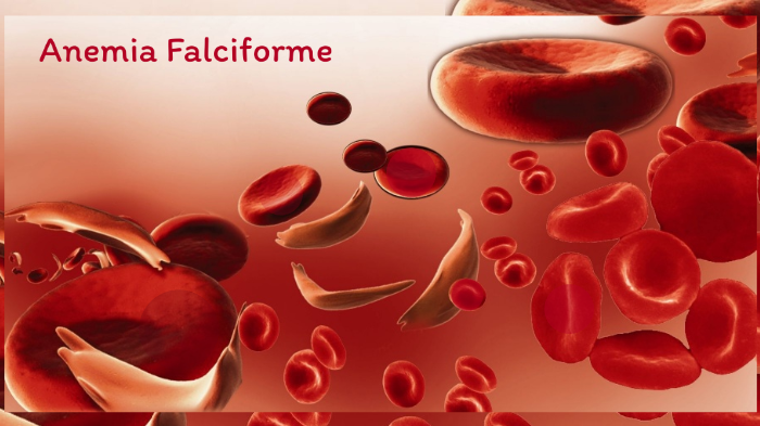 Anemia Falciforme By Debora Sampaio On Prezi 0008