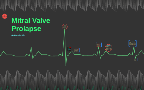 Mitral Valve Prolapse by Danielle Blixt on Prezi