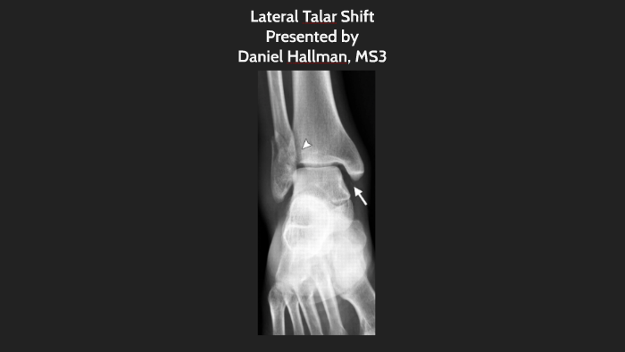 Lateral Talar Shift By Daniel Hallman On Prezi