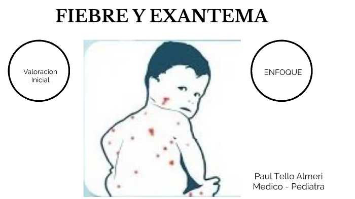 Fiebre Y Exantema By Paul Tello On Prezi