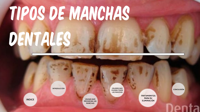 tipos de manchas dentales. Isabel Montiel by isabel montiel on Prezi