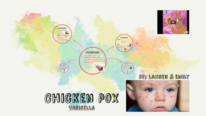 Chicken pox by Lauren Bhargava on Prezi