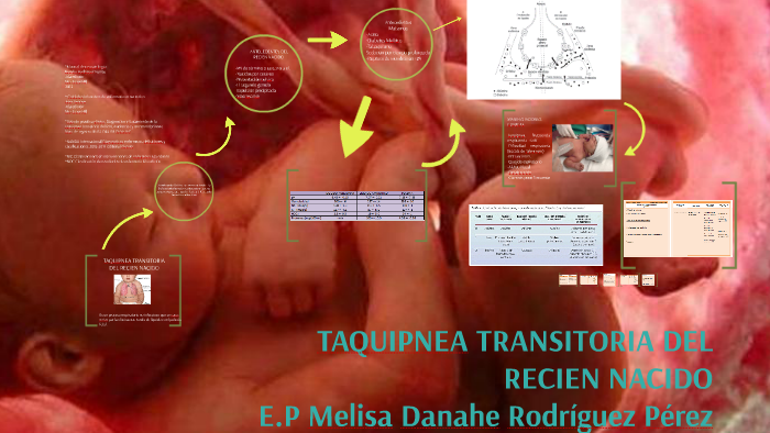 taquipnea transitoria del recién nacido