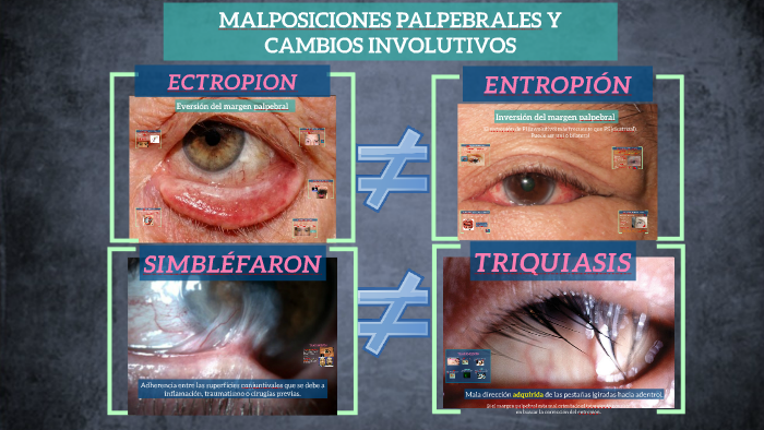 Malposiciones Palpebrales Y Cambios Involutivos By Laura Campi