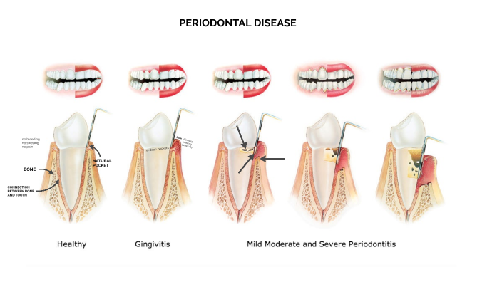 Gingivitis Parodontitis by zuza vasick