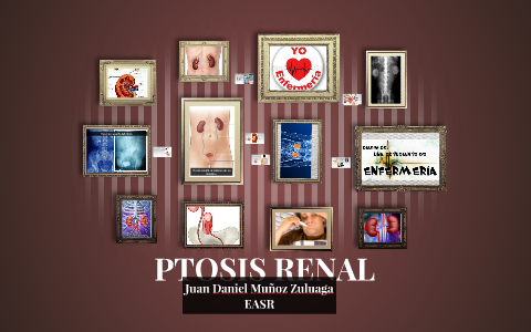 PTOSIS RENAL by juan daniel muñoz zuluaga