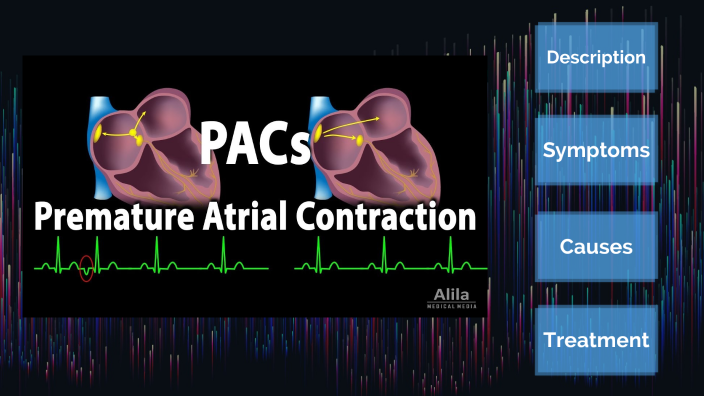 Premature Atrial Contraction by Caity Rice on Prezi