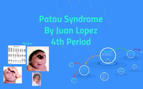 patau syndrome symptoms pictures