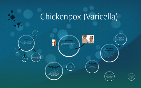 Chicken Pox by Dlonra Pasao on Prezi