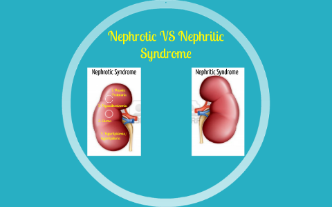 Nephrotic VS Nephritic Syndrome by on Prezi