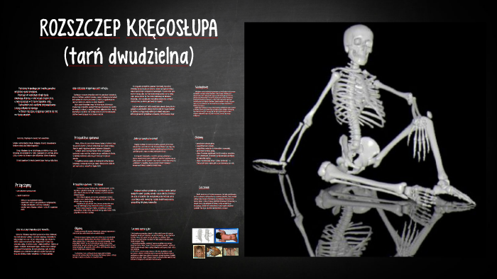 Rozszczep Kregoslupa By Joanna Turkoc